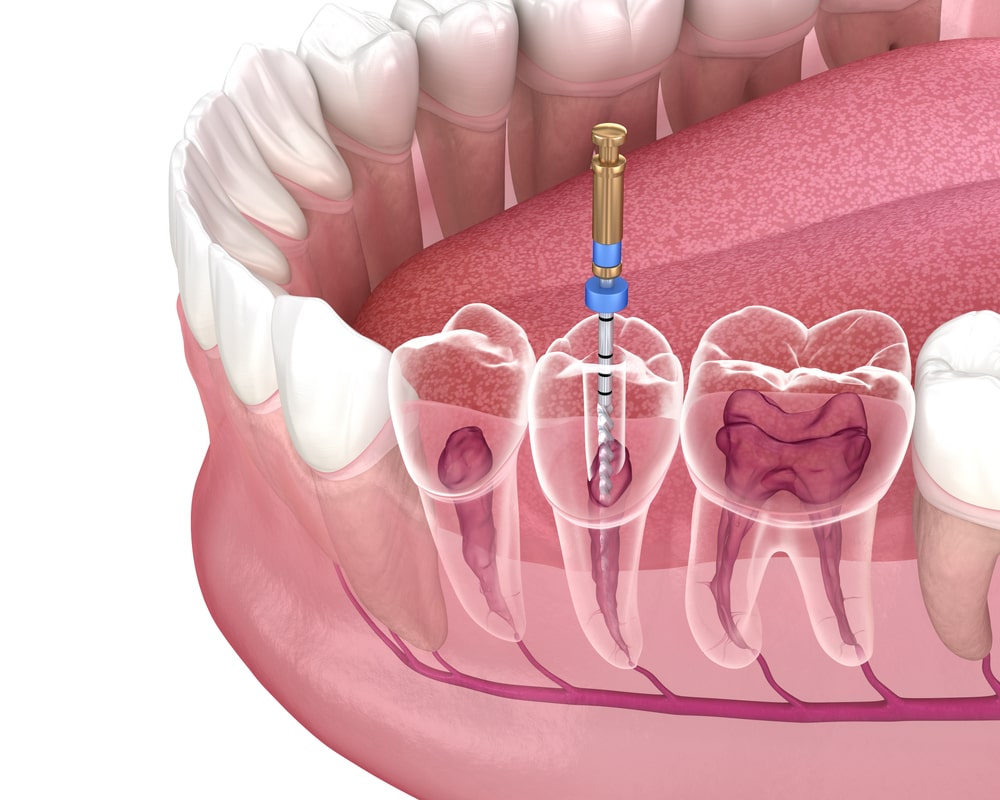 root canal treatment